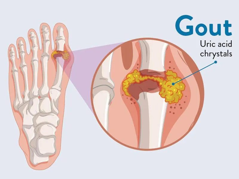 does-milk-harm-arthritis