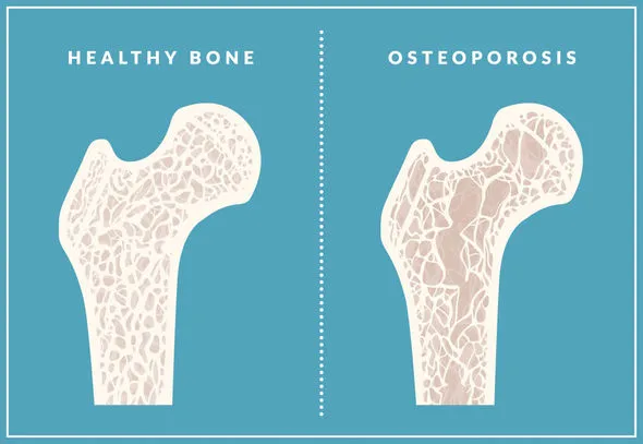 milk-for-adults-helps-prevent-osteoporosis