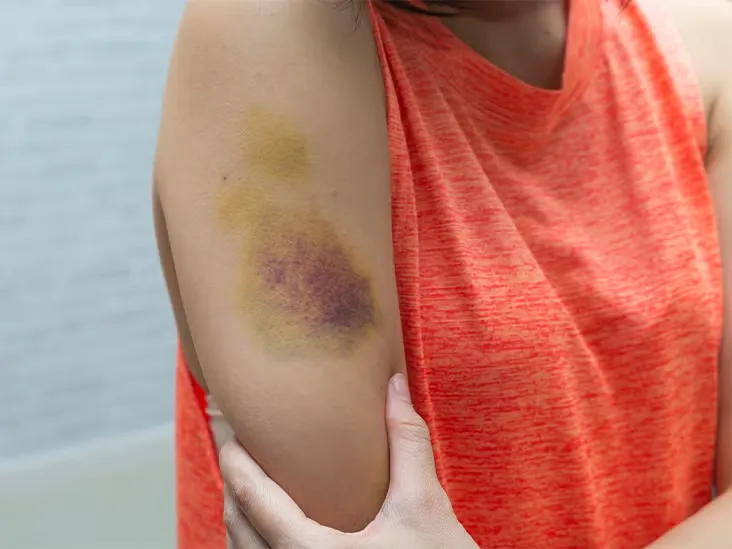 why-bruises-appear-on-the-body