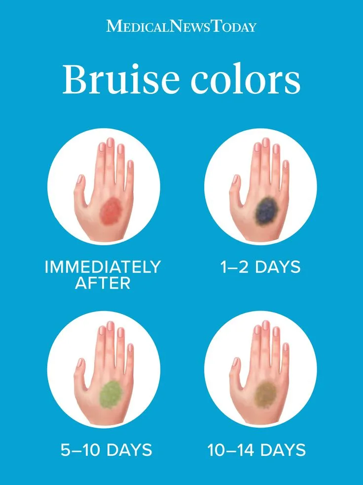 why-bruises-appear-on-the-body