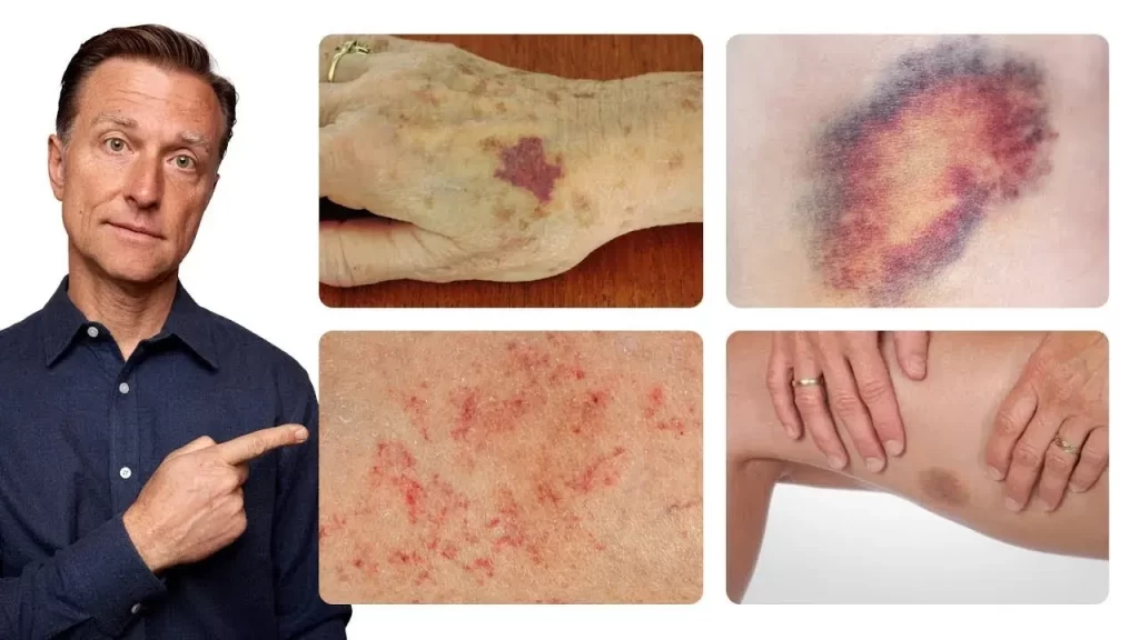 why-bruises-appear-on-the-body